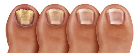 What Causes Thick Toenails Causes Symptoms And Treatments To Get Rid