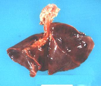 If your baby's lungs aren't fully developed by the time they're born, they may have problems breathing. Red, consolidated and hypocrepitant lungs in hyaline ...