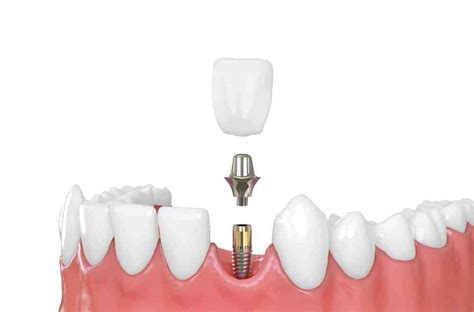 How Long Does Dental Implant Surgery Take Dental News Network