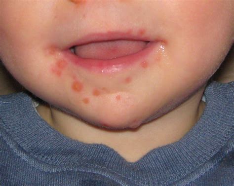 Zapalenie Jamy Ustnej U Dziecka Opryszczkowe Aftowe Grzybicze