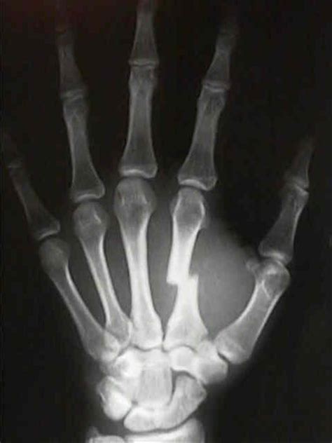 2nd Metacarpal Fracture Right Hand