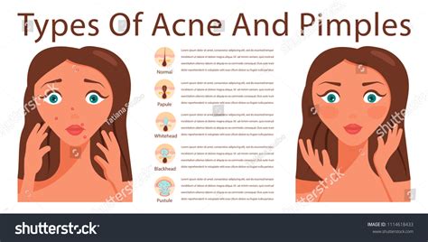 Types Acne Pimples Human Skin Poster Image Vectorielle De Stock