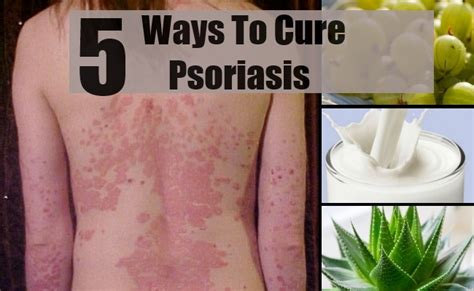 5 Effective Remedies To Cure Psoriasis Find Home Remedy And Supplements
