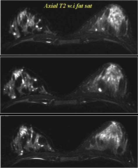 Sclerosing Adenosis Mimicking Breast Carcinoma Eurorad