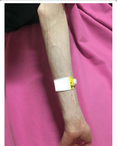 Urticarial Rash On Left Forearm After Receiving Tpn At 2785 Mosmolkg