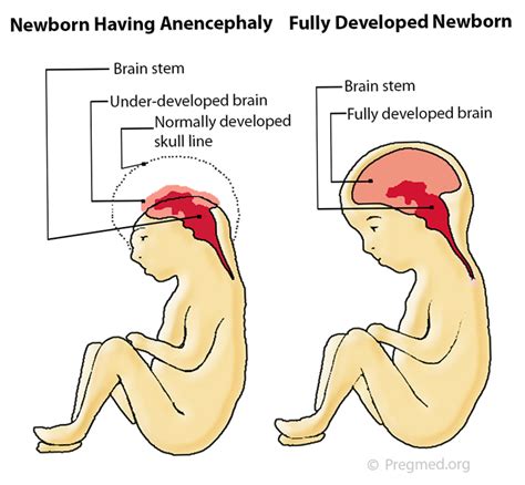 Anencephaly Fetal Health Foundation