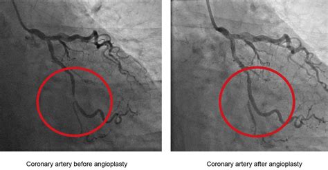 Angioplasty Stents Heart Foundation