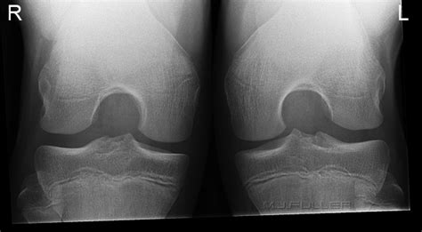 Supine Intercondylar Knee Radiography Wikiradiography