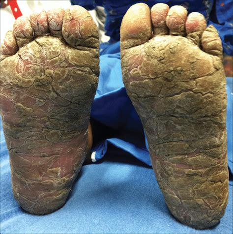 Hyperkeratotic Lesions On Feet