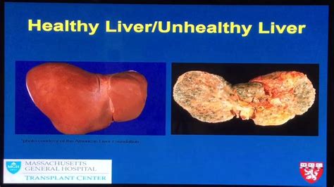 Mgh Liver Transplant Patient Education Overview Hd 71617 Youtube