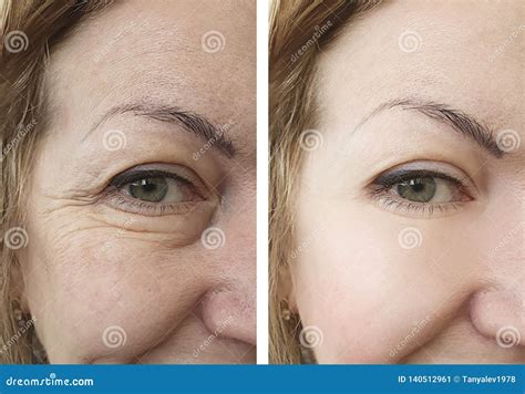 Woman Wrinkles Mature Correction Results Contrast Before And After