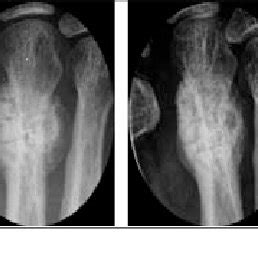 Ë healing of bone goes through a number of stages. Bone healing stages of metatarsal bone fracture monitored ...