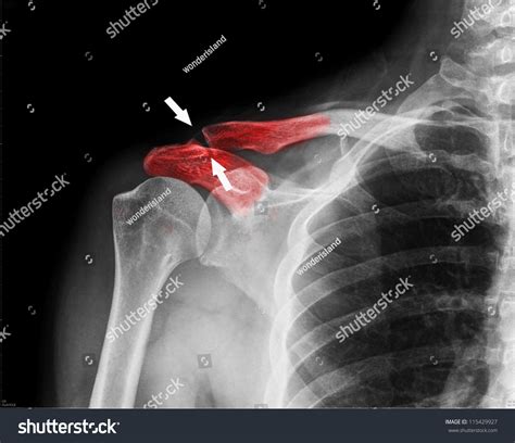 X Ray Of Collarbone Stock Photo 115429927 Shutterstock