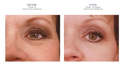 Wrinkles Puffiness And Dark Under Eye Circles Got You Down Check Out