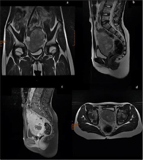 A Coronal Mri View Showing A Right Ovarian Tumor With Irregular Seams