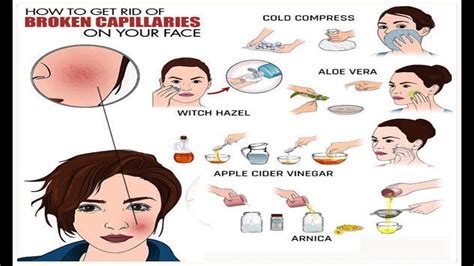 How To Get Rid Of Broken Capillaries On Your Face Youtube