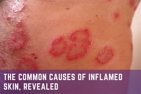 The Common Causes Of Inflamed Skin Revealed Theraderm® Clinical Skin