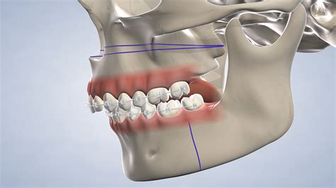 Post Operative Instructions Following Orthognathic Jaw Surgery At
