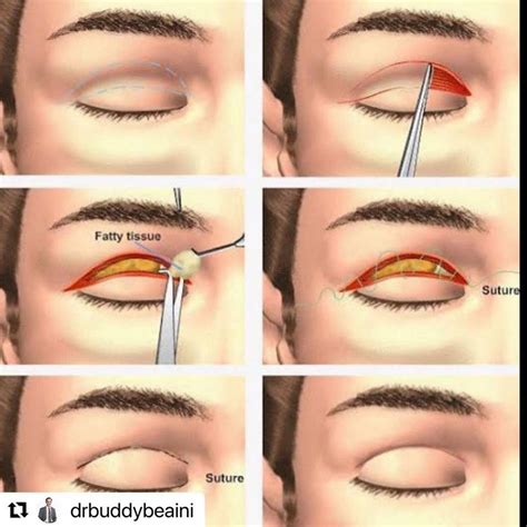 Vicky Lambrinos On Instagram “upper Eyelid Hooding Blepharoplasty