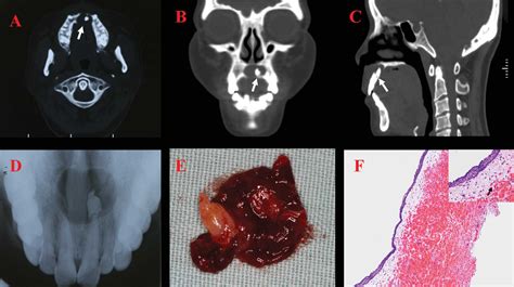 Dentigerous Cysts Associated With Impacted Supernumerary Teeth In The