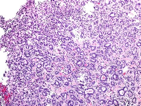 Pathology Outlines Epithelial Myoepithelial Carcinoma