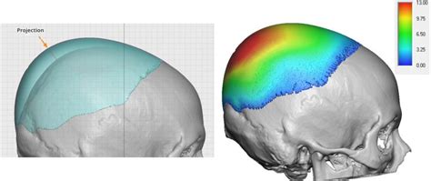 Plastic Surgery Case Study Custom Skull Implant For Female Crown