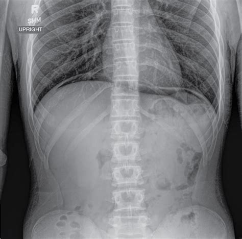 Abdominal Radiography Radiology Key