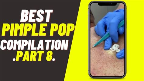 Popping Huge Blackheads And Pimples😱 Pimple Popper Best Videos