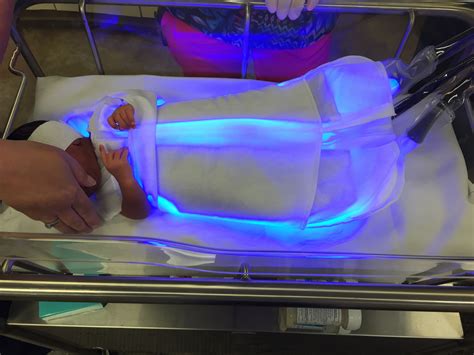 Phototherapy For Jaundice Babies