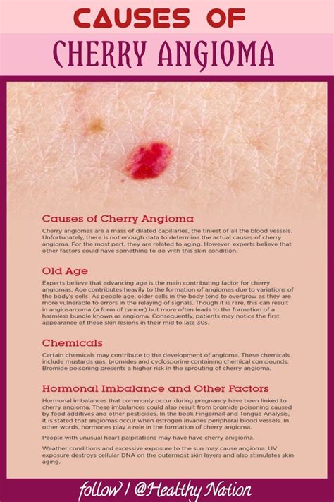 Causes Of Cherry Angioma Cherry Angioma Healthy Life Hacks Natural