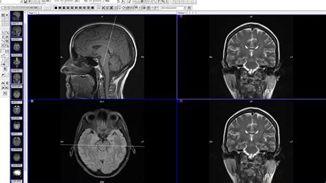 Brain Mri Of 70 Year Old With Chronic Nausea And Poor Balance Normal