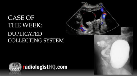 Case Of The Week Duplicated Collecting System Vcug And Ultrasound