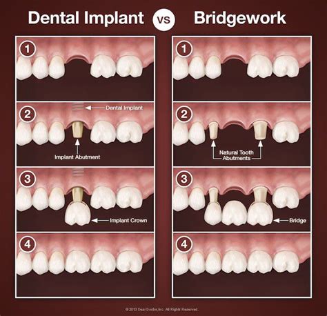 Dental Implants All You Ever Need To Know Dental Implants Dental