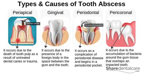 Tooth Abscess Treatment With Pictures Share Dental Care