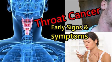 Early Signs Of Throat Cancer That Is Growing In Your Body Youtube