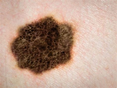Stage Iv Melanoma Of Unknown Primary Physician S Weekly