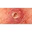 Squamous Cell Carcinoma  Q Dermatology