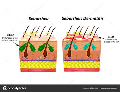 Causes Seborrhea Skin Hair Dandruff Seborrheic Dermatitis Eczema