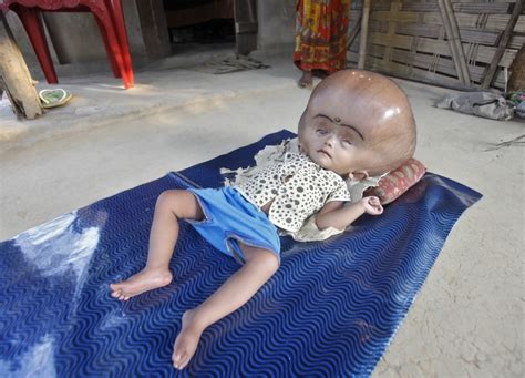 Meet Roona Begum 18 Month Old Girl With Abnormally Large