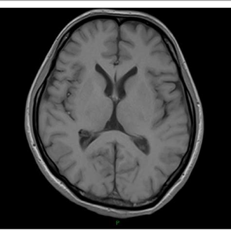 T1 Weighted Head Mri Showing Lateral Ventricles And The Third Ventricle