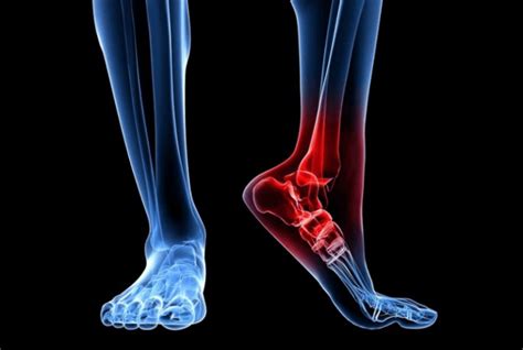 Ankle Osteoarthritis Causes And Treatment Eat Right