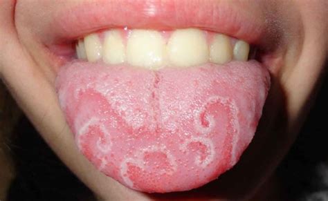 What Is Glossitis What Are The Causes Symptoms Types And Treatment Of The Glossitis