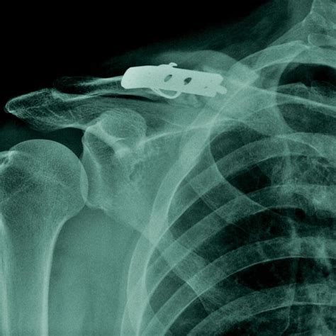 Clavicle Fracture Broken Collar Bone Shoulder Specialist South