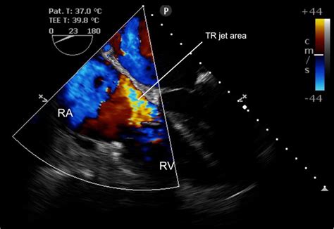 Mild Tricuspid Regurgitation Mid Oesophageal 4 Chamber View At Frame