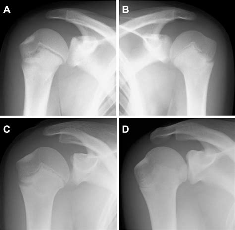 Humeral Retroversion And Injury Risk After Proximal Humeral
