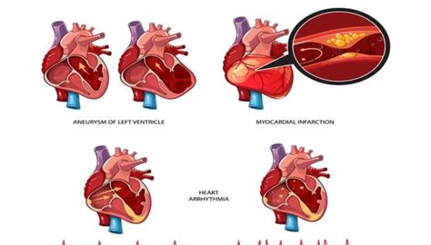 Cardiogenic Shock Symptoms Causes Prevention Dr Website