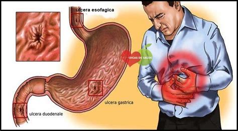 Os Principais Sintomas Da Gastrite Nervosa ATUALIZADO