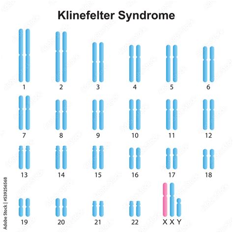 Scientific Designing Of Klinefelter Syndrome XXY Karyotype Colorful