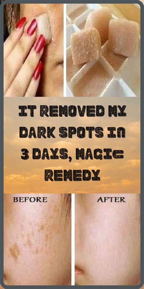 Im Shocked It Removed My Dark Spots In 3 Days Magic Remedy Remedies