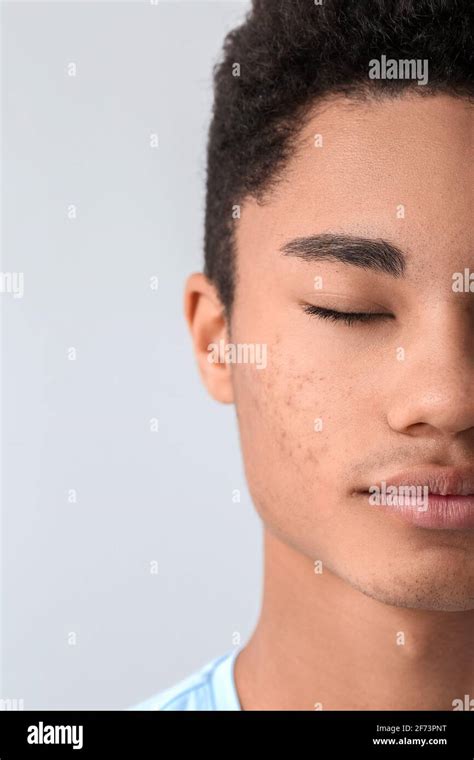 African American Teenage Boy With Acne Problem On Light Background